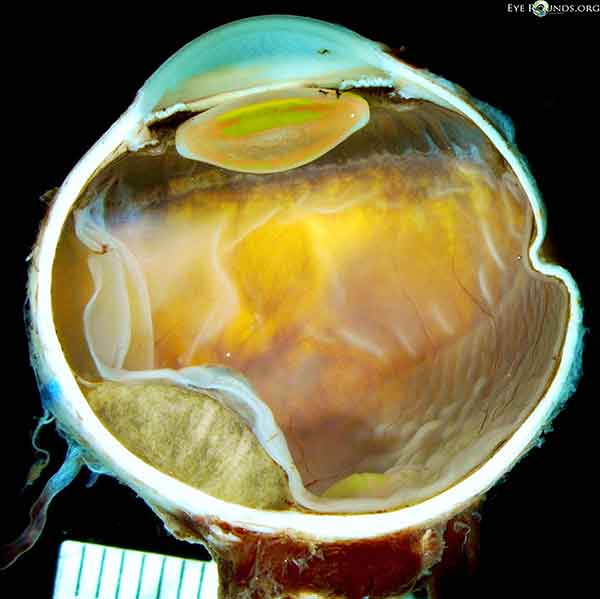 Gross specimen of the globe after enucleation showing posterior choroidal mass with adjacent retinal detachment. 