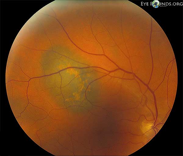 Biconvex shape with orange pigment overlying the mass and subretinal fluid inferonasal to the lesion.