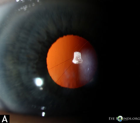 Slit lamp photo demonstrating posterior capsluar folds