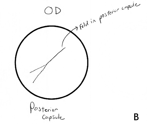 Physician Drawing of the fold