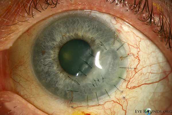 appearance after lamellar keratoplasty