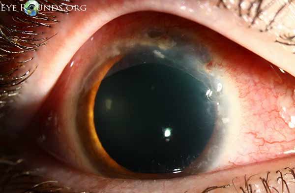 Superior epithelial defect with 80% stromal thinning and adjacent sterile corneal infiltrates