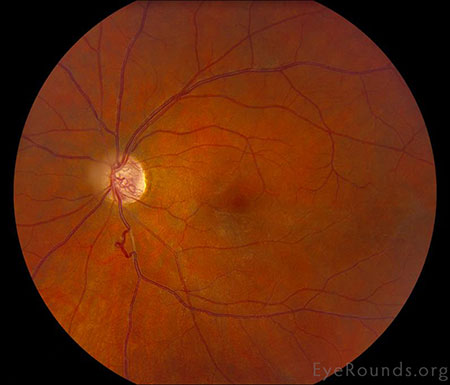 Color Fundus, left eye