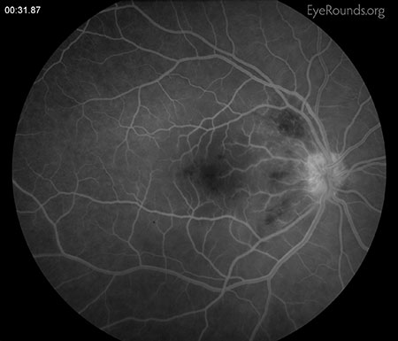 Small punctate areas of early hypofluorescence in the peri-foveal region in the area of the cotton wool spot just supratemporal to disc. 