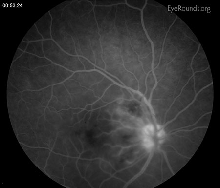 erivenular phlebitis is noted in mid frames