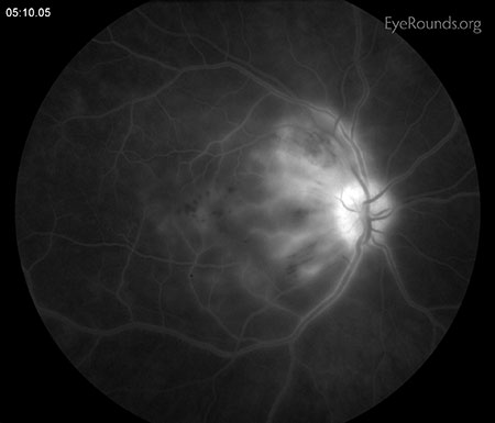 Late hyperfluorescence and leakage around the disc in area of cotton wool spot. 