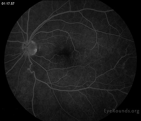 Late leakage from the infero-temporal venous vasculature with mild inferior peripheral periphlebitis with late hyperfluorescence.