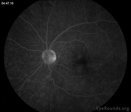 Late leakage from the infero-temporal venous vasculature with mild inferior peripheral periphlebitis with late hyperfluorescence.