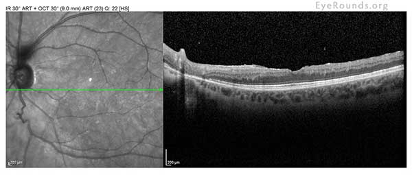 mild ERM; no CME or SRF 