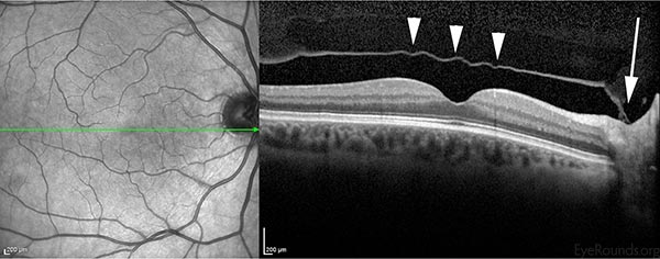 Oct of the macula