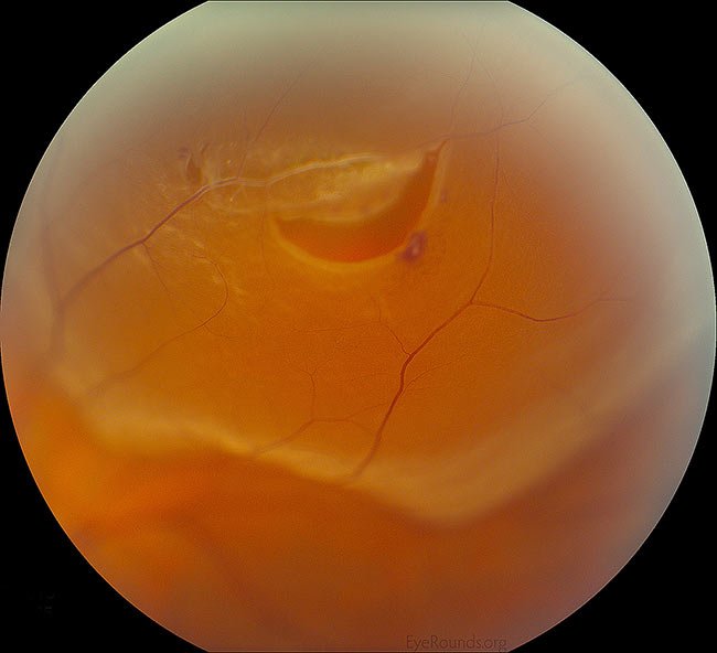 High magnification of a peripheral horseshoe retinal tear adjacent to lattice degeneration, a retinal vessel, and specks of intraretinal hemorrhage