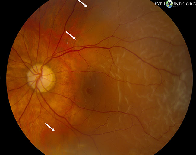 Low magnification montage, rhegmatogenous macula-off retinal detachment