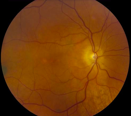 right eye fundus