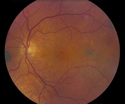 left eye fundus