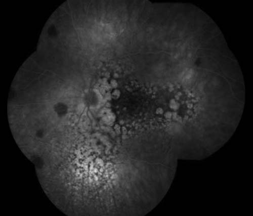 Left eye. fluorescein angiography