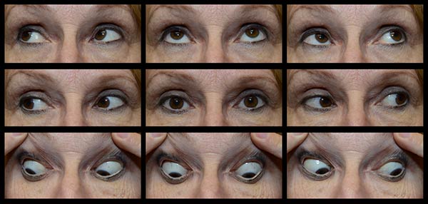 Figure 2: The patient had a very small angle, comitant left hypertropia (LHT). She adopted a compensatory right head tilt (not shown) and there was 5 degrees of excyclotorsion OD and 7 degrees of incyclotorsion OS with double Maddox rod (DMR) testing (see Figure 3). The alignment did not improve with earth neutral positioning. 