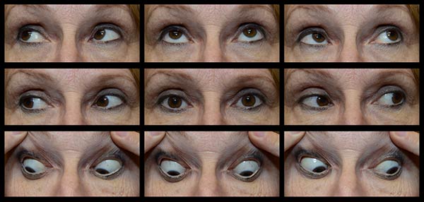 Figure 2: The patient had a very small angle, comitant left hypertropia (LHT). She adopted a compensatory right head tilt (not shown) and there was 5 degrees of excyclotorsion OD and 7 degrees of incyclotorsion OS with double Maddox rod (DMR) testing (see Figure 3). The alignment did not improve with earth neutral positioning. 