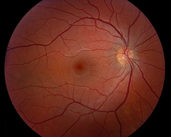 Excyclotorsion OD and incyclotorsion OS 