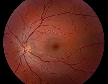 Excyclotorsion OD and incyclotorsion OS 