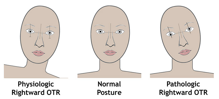 Left: A physiologic ocular tilt reaction (OTR) in response to a left body tilt in the roll plane – there is a compensatory right head tilt with downward rotation and excyclotorsion of the right eye and upward rotation and incyclotorsion of the left eye. Right: A pathologic OTR will have the same changes in head posture, eye position and rotation as the physiologic OTR in the absence of a change in body position in the roll plane to stimulate it. [adapted from 1] 