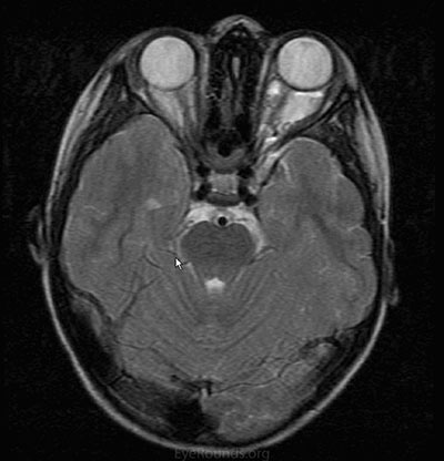 c) Axial T2 image demonstrates minute fluid-fluid levels.