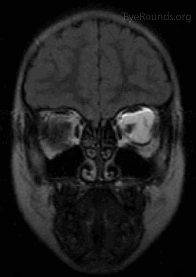 d) Coronal flair image showing left orbital mass.