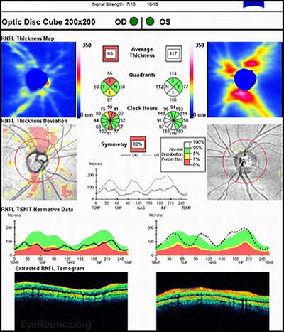 OCT of the RNFL: Note the superior and inferior thinning OD. OS appears normal.