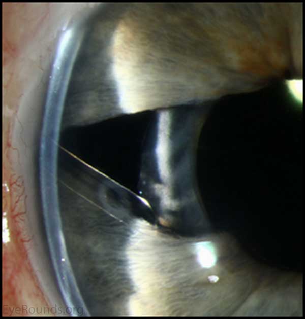 Superior and temporal tube well covered by conjunctiva and donor cornea. The tube enters the anterior chamber over the area iridectomy to decrease the potential of abnormal cells endothelial cells from occluding the tube. 