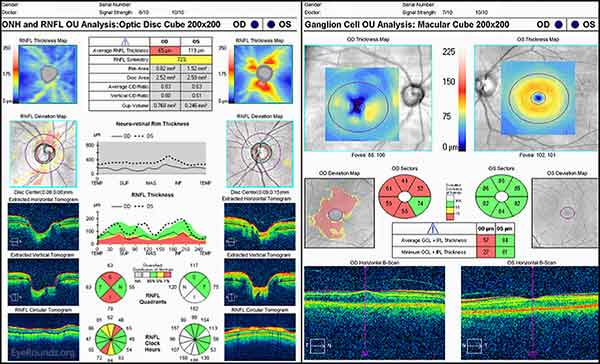 OCT of the optic nerve head and the ganglion cell layer: There is progression of the glaucomatous damage with retinal nerve fiber thinning and ganglion cell layer thinning. 