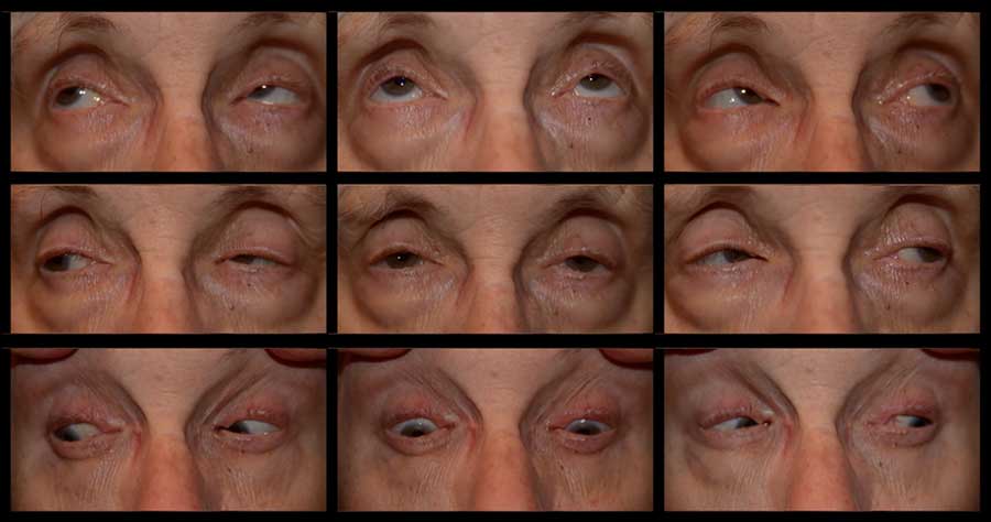 Strabismus Exam