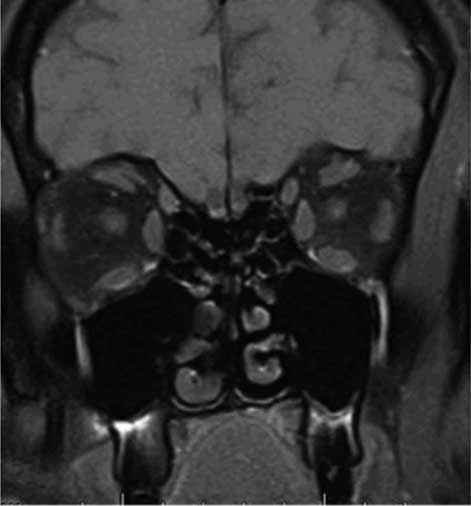 the lateral rectus muscles in the normal patient