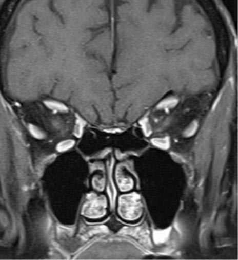 our patient with sagging eye syndrome the right that has inferomedial displacement of the lateral recti