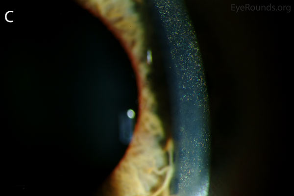 slit lamp closer, Punctate, needle-shaped crystals diffusely present throughout the corneal surface