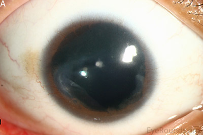 corneal pannus, subepithelial haze, and iris hypoplasia