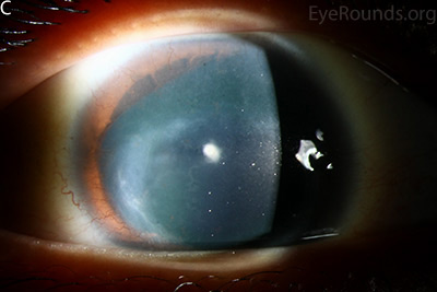 corneal pannus, subepithelial haze, and iris hypoplasia