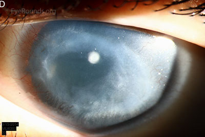 corneal pannus, subepithelial haze, and iris hypoplasia