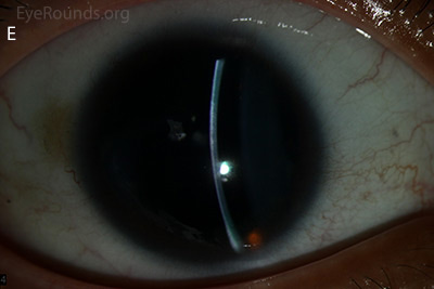 corneal pannus, subepithelial haze, and iris hypoplasia