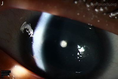 small anterior polar cataracts