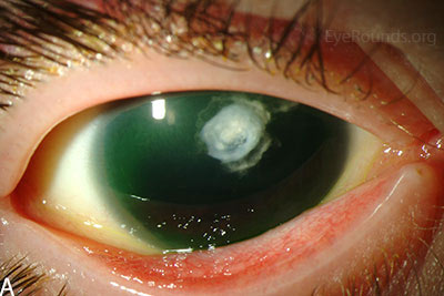 Slit lamp photographs of another patient with congenital aniridia. There is conjunctivalization of the left cornea due to stem cell deficiency and a central corneal scar. There is iris hypoplasia in both eyes.