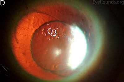 patient with congenital aniridia has 3-piece posterior chamber intraocular lenses in both eyes, as seen on retroillumination