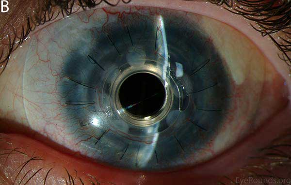 Postoperative appearance of the patient in Figure 3 after placement of a Boston keratoprosthesis (KPro).