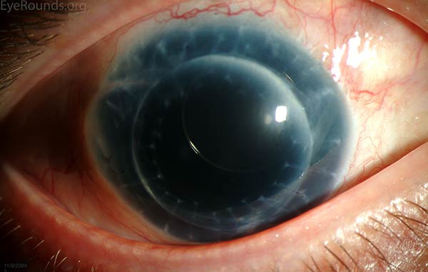 A Morcher intraocular lens in an eye with a full-thickness corneal transplant and traumatic aniridia.