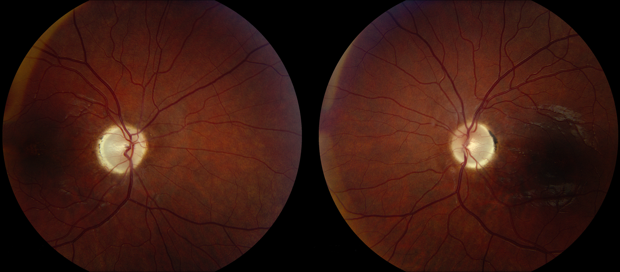 Нейропатия глаза. Глазное дно миелиновые волокна. Ретробульбарный неврит офтальмоскопия.