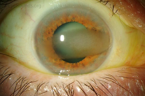 Band-shaped, horizontal, gray-white, subepithelial opacity in the interpalpebral fissure with involvement of the visual axis. A moderately dense nuclear sclerotic cataract is present. This particular type of band keratopathy responds favorably with superficial keratectomy followed by EDTA chelation. Manual polishing with a diamond burr or excimer laser will not be needed if the underlying Bowman's layer is a smooth optical surface.