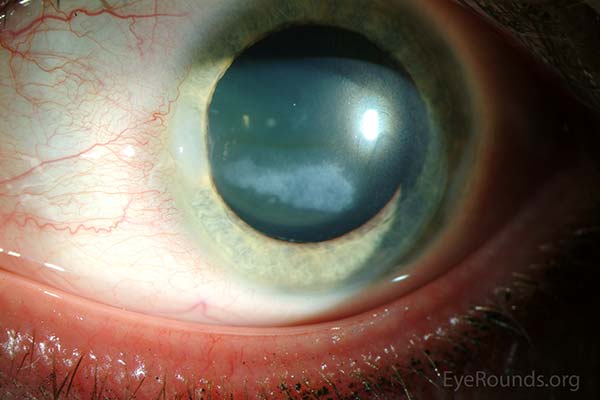 Early band keratopathy, with a surrounding iron line, associated with juvenile idiopathic arthritis. The accompanying iron line denotes the chronicity of the lesion. 