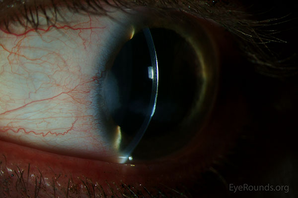 slit lamp. Early band keratopathy, with a surrounding iron line, associated with juvenile idiopathic arthritis. The accompanying iron line denotes the chronicity of the lesion. 