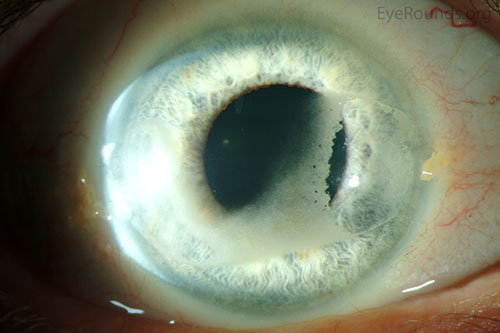 Paracentral band keratopathy associated with hyperparathyroidism that is inducing irregular astigmatism.