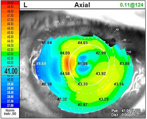 Axial. Paracentral band keratopathy associated with hyperparathyroidism that is inducing irregular astigmatism.