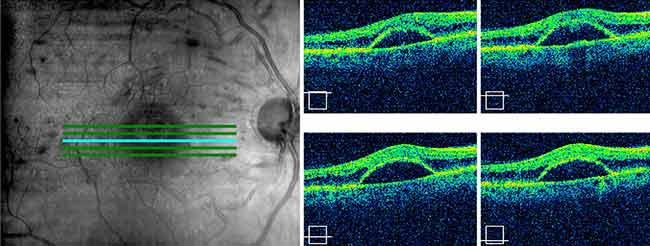 There is a large fovea-involving, serous macular detachment with pockets of overlying intraretinal fluid.