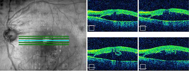 There is a moderately sized fovea-involving, serous macular detachment with minimal intraretinal fluid.